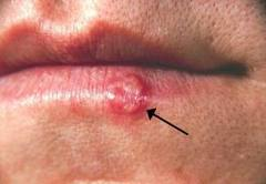 Treatment for Cold Sores